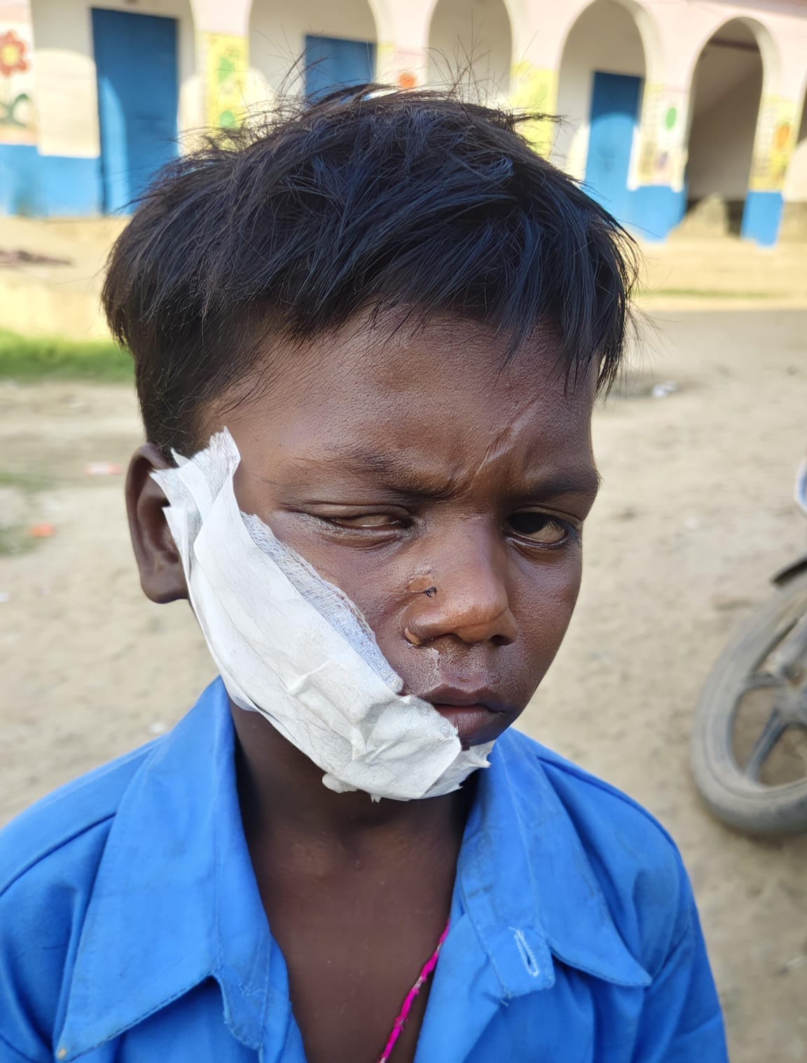 नाथनगर के स्कूल में गैस से विस्फोट, पहली कक्षा का छात्र झुलसा – प्रशासनिक लापरवाही पर अभिभावकों में आक्रोश